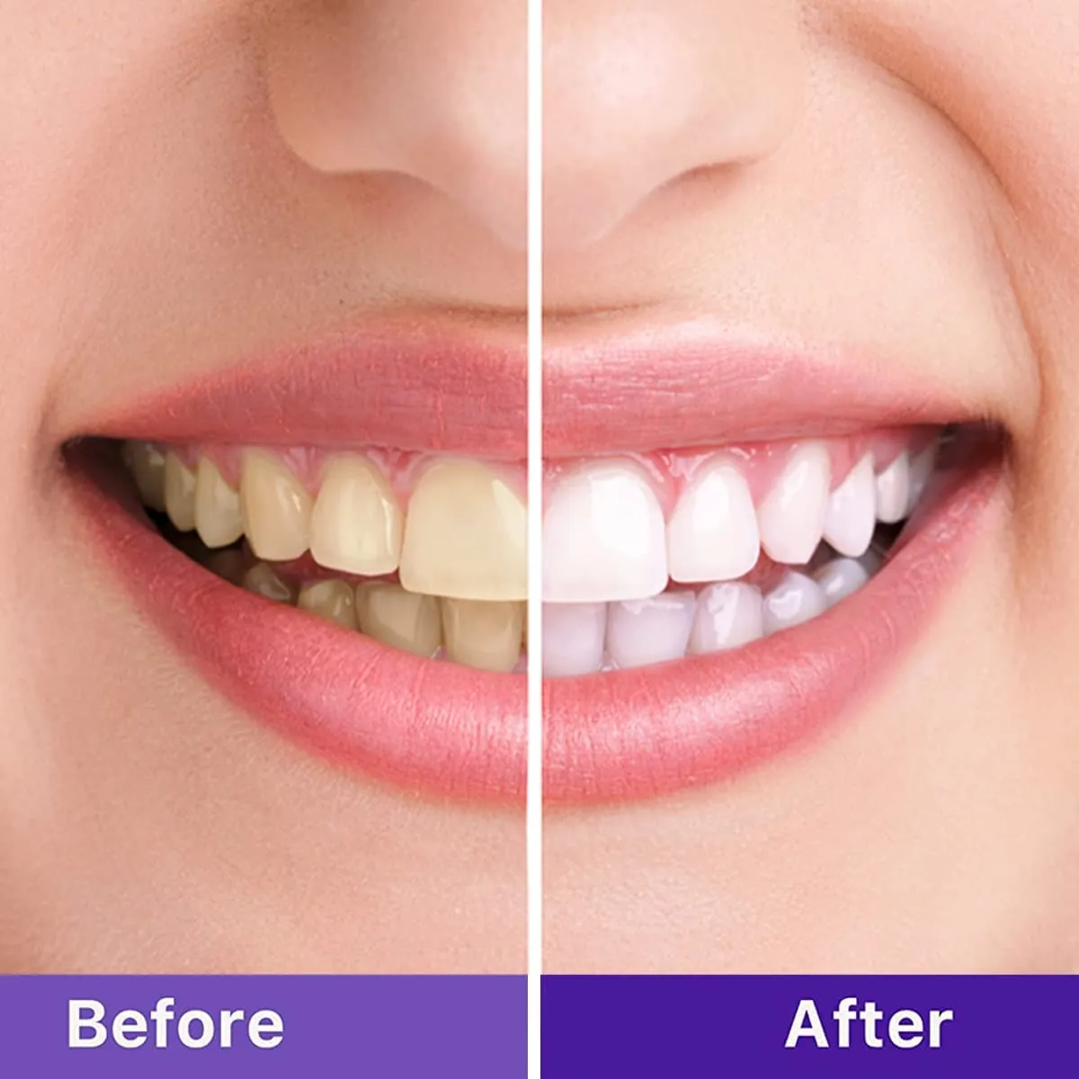 25632 purple teeth whitening overview