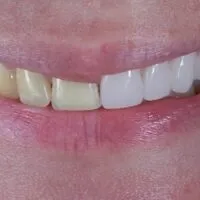25635 teeth sensitivity