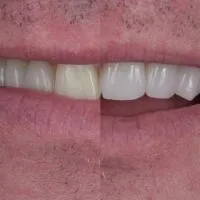 25635 tijuana dentist consultation