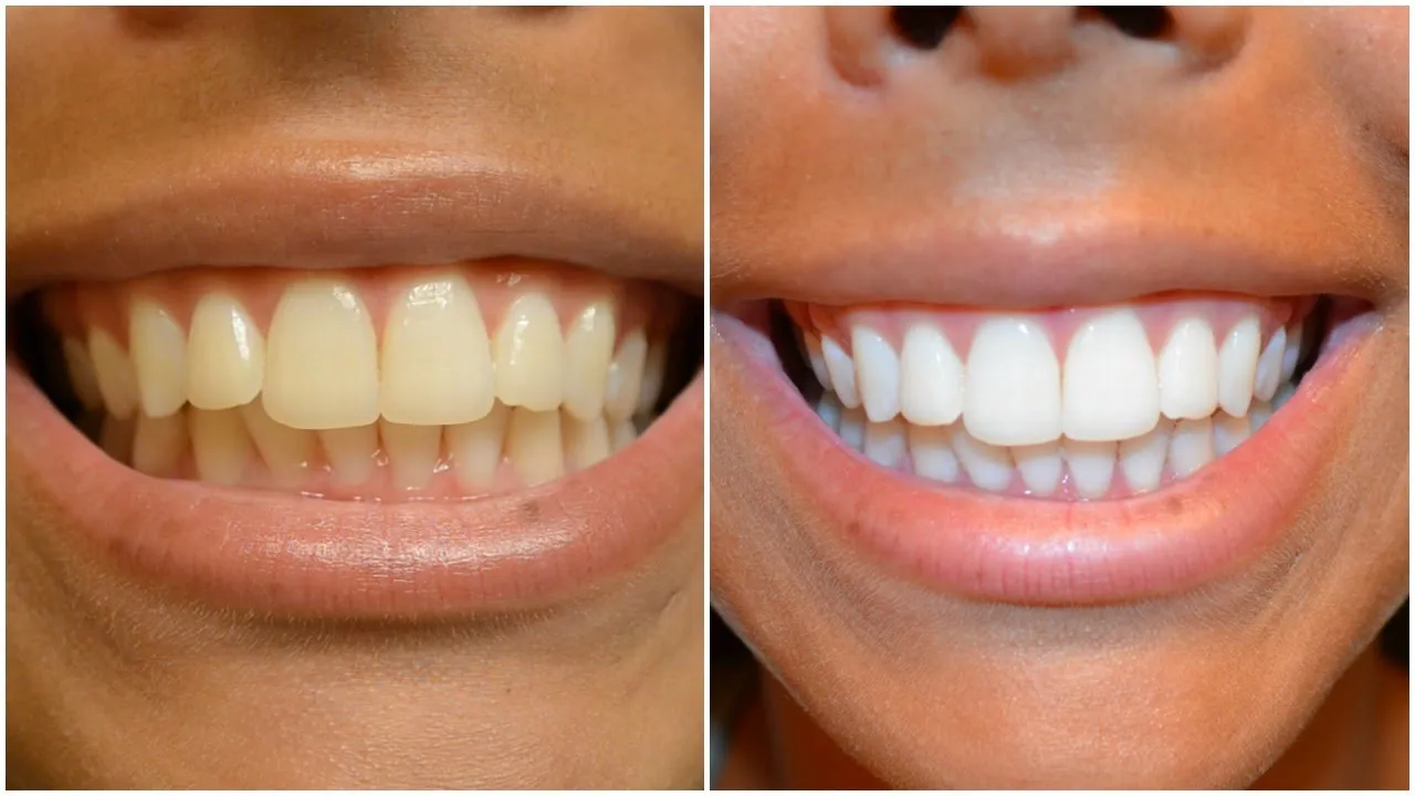25638 dg health whitening strips packaging