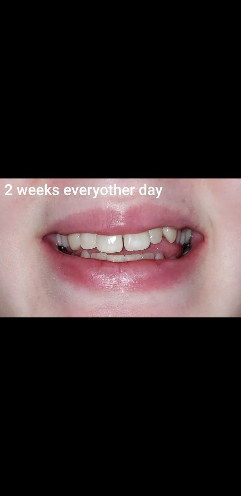 25641 charcoal brushing teeth
