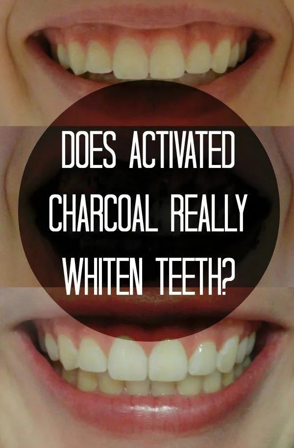 25641 charcoal teeth whitening overview
