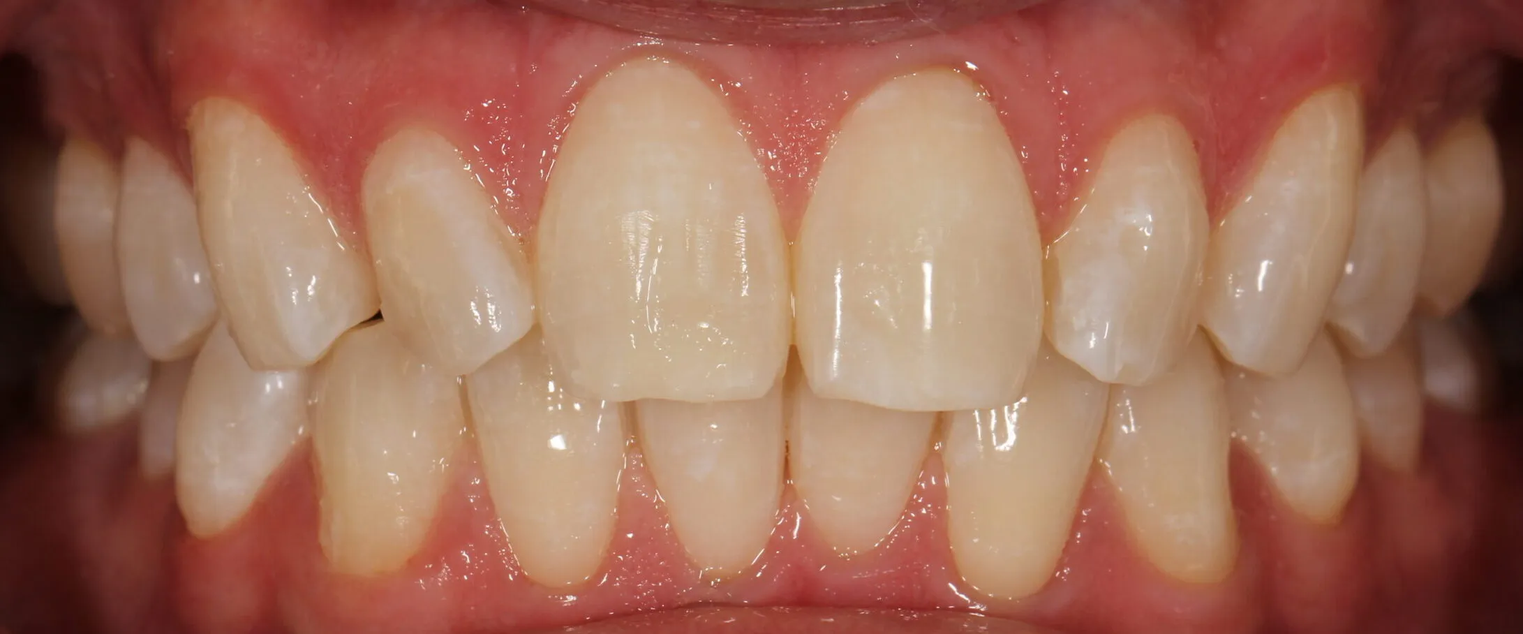 25642 gentle brushing