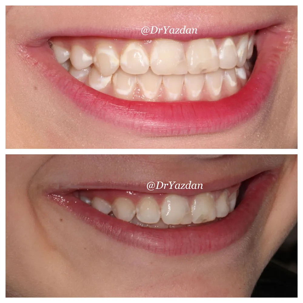 25642 gum irritation