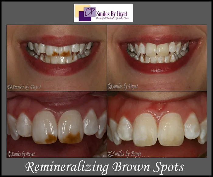 25642 teeth sensitivity