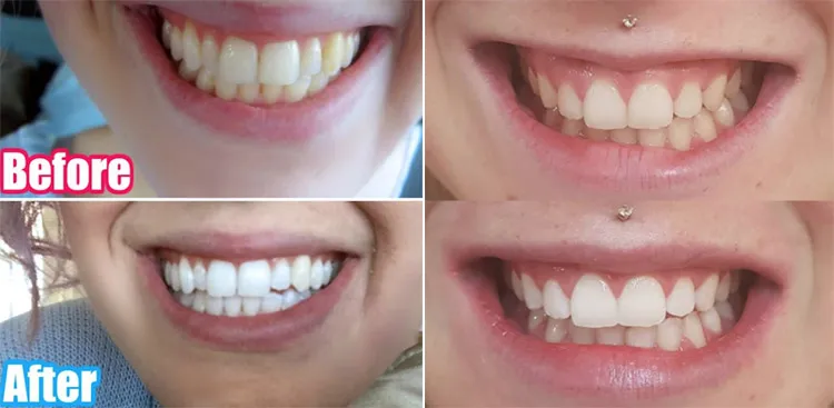 25643 sensitive teeth whitening 4