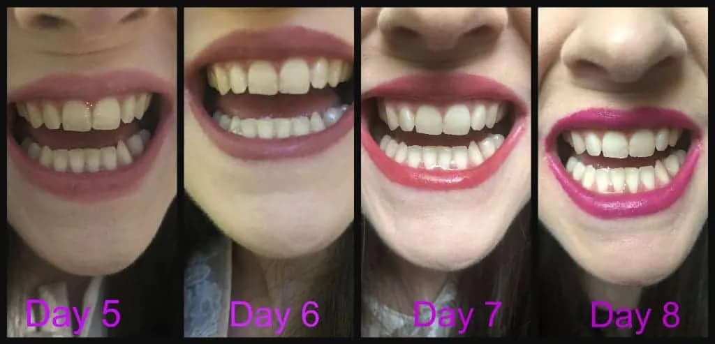 25643 sensitive teeth whitening 5
