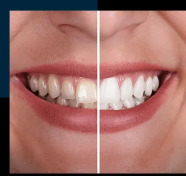 25646 teeth whitening methods