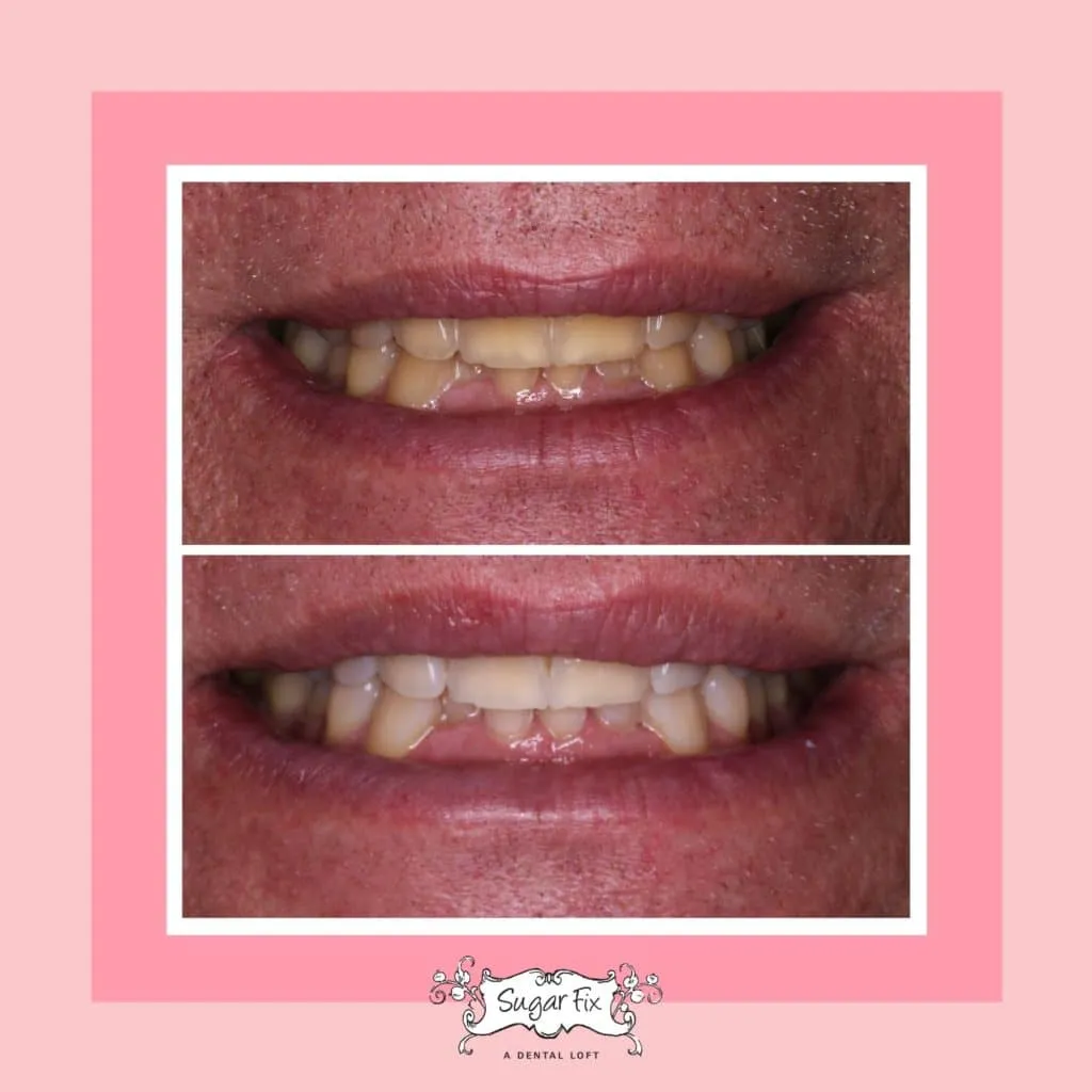 25648 at home teeth whitening