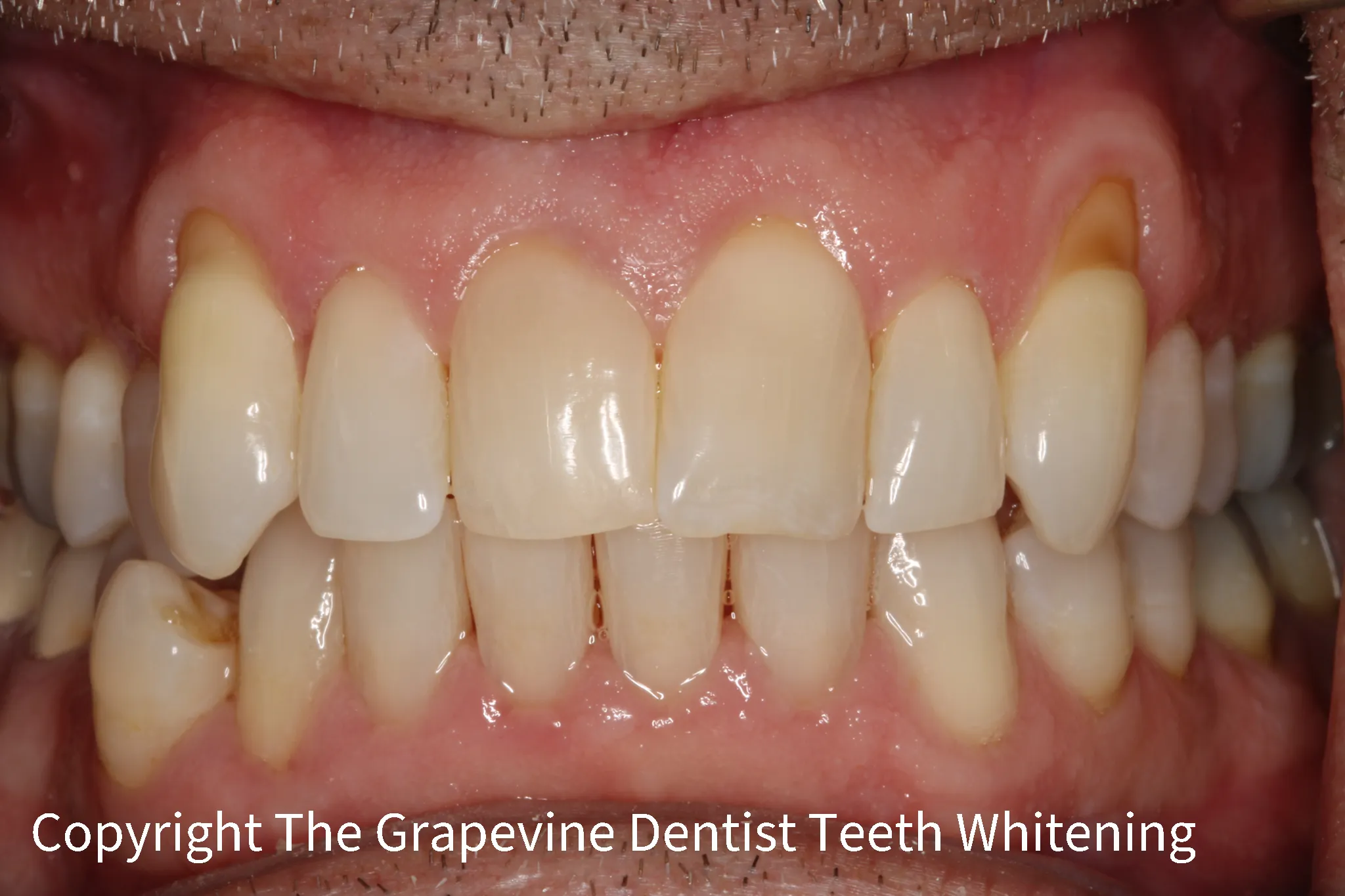 25649 white diet after teeth whitening image3