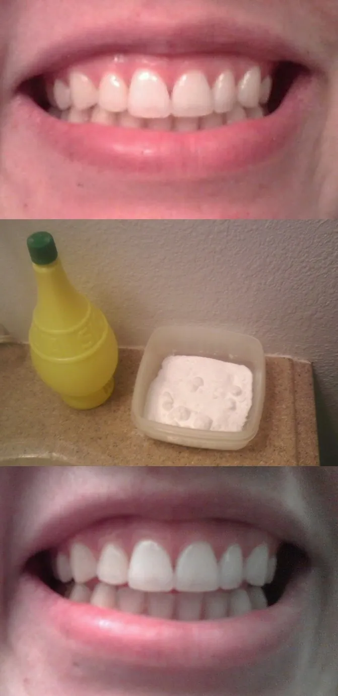 25653 bicarbonate teeth whitening 1