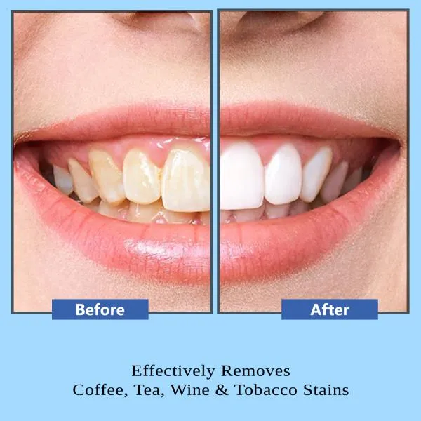 25653 bicarbonate teeth whitening 2