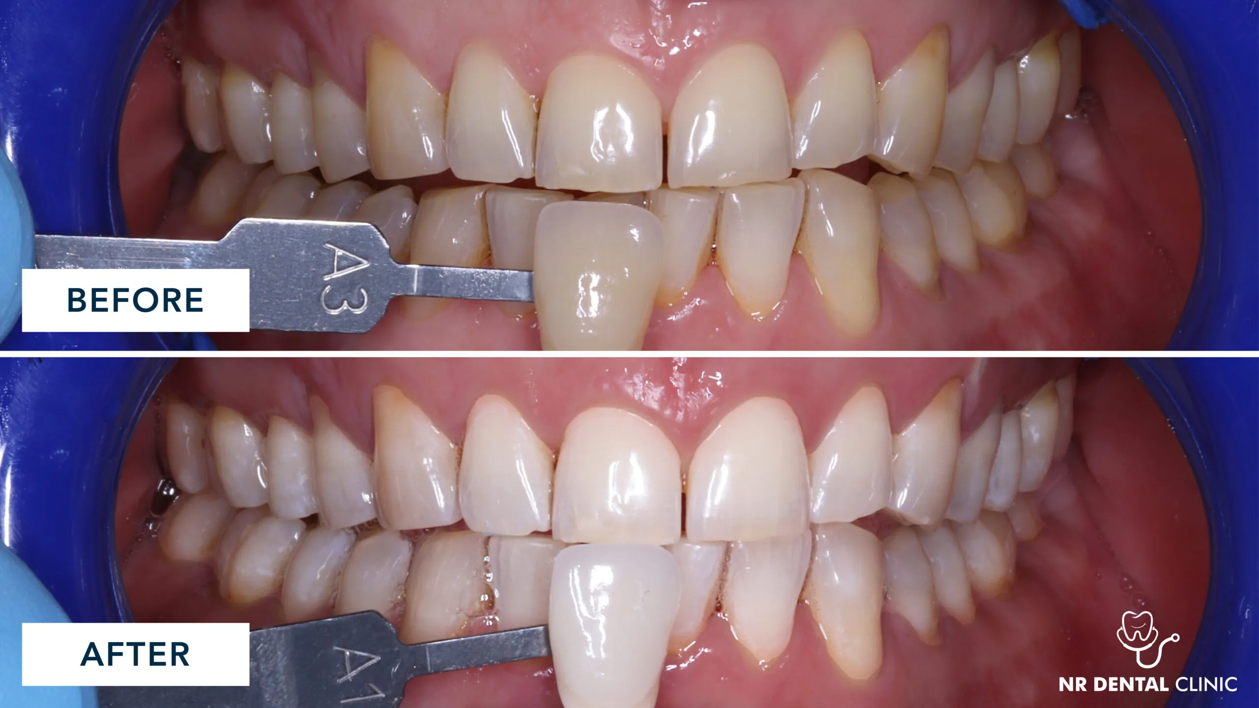 25655 invisalign aligners in mouth