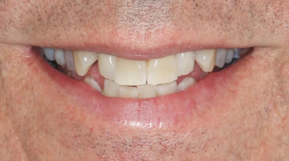 25655 invisalign whitening before after