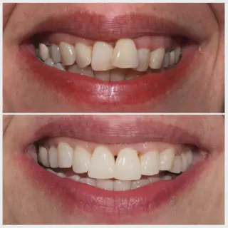 /img/25655-perfect-smile-teeth.webp