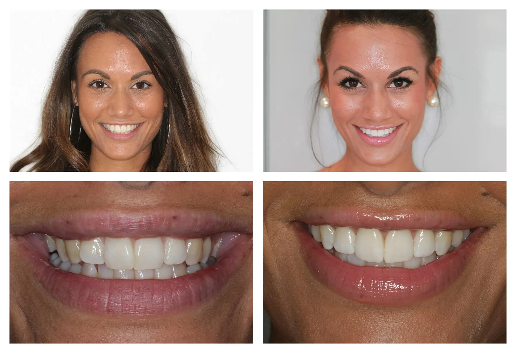 25655 professional teeth whitening
