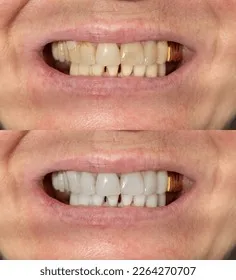/img/25656-maintaining-white-smile.webp