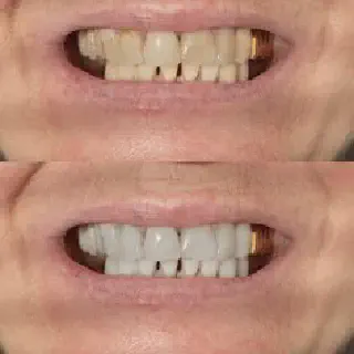 /img/25656-maintaining-white-smile.webp