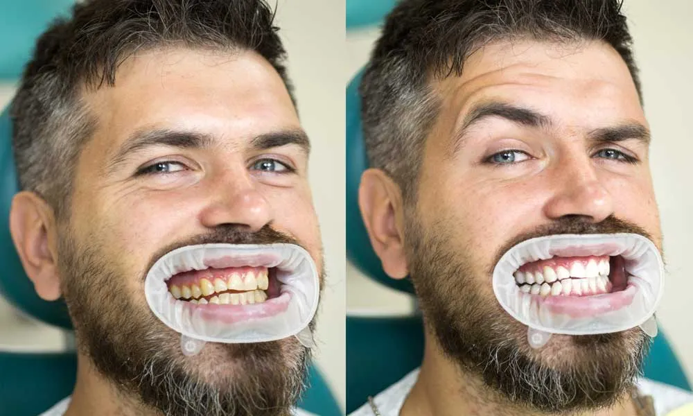 25656 teeth whitening benefits