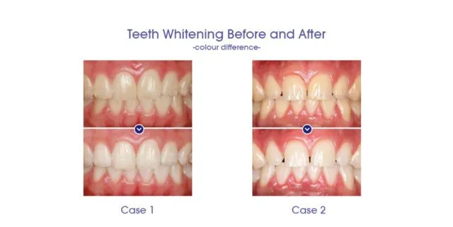 25656 teeth whitening results