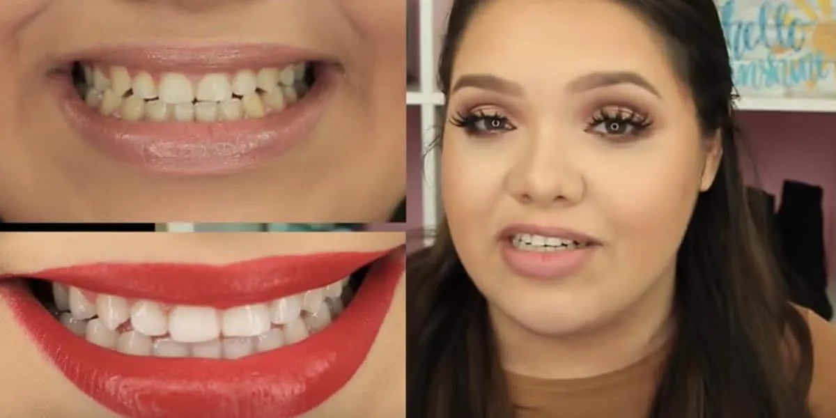 25658 teeth whitening hacks