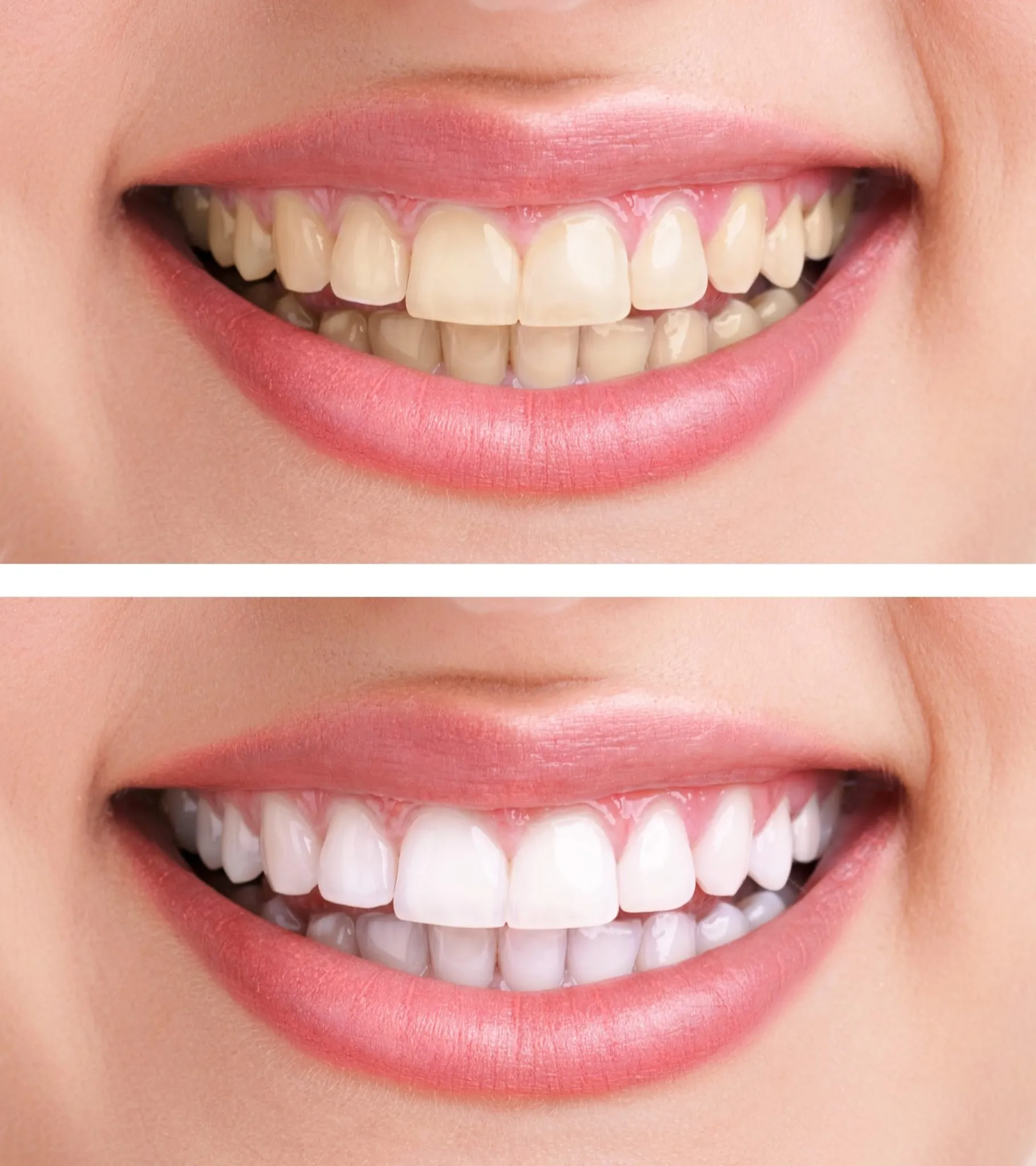 25660 before after teeth whitening