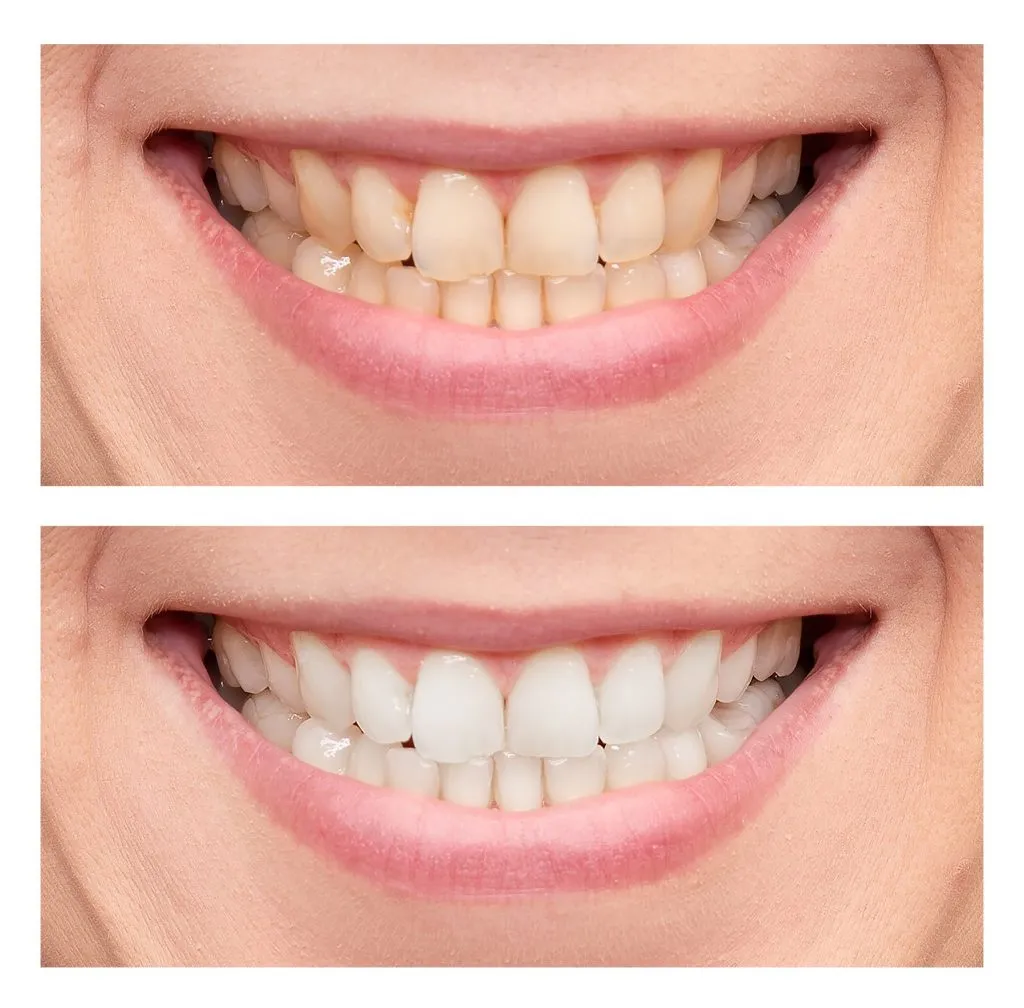 25660 teeth whitening methods