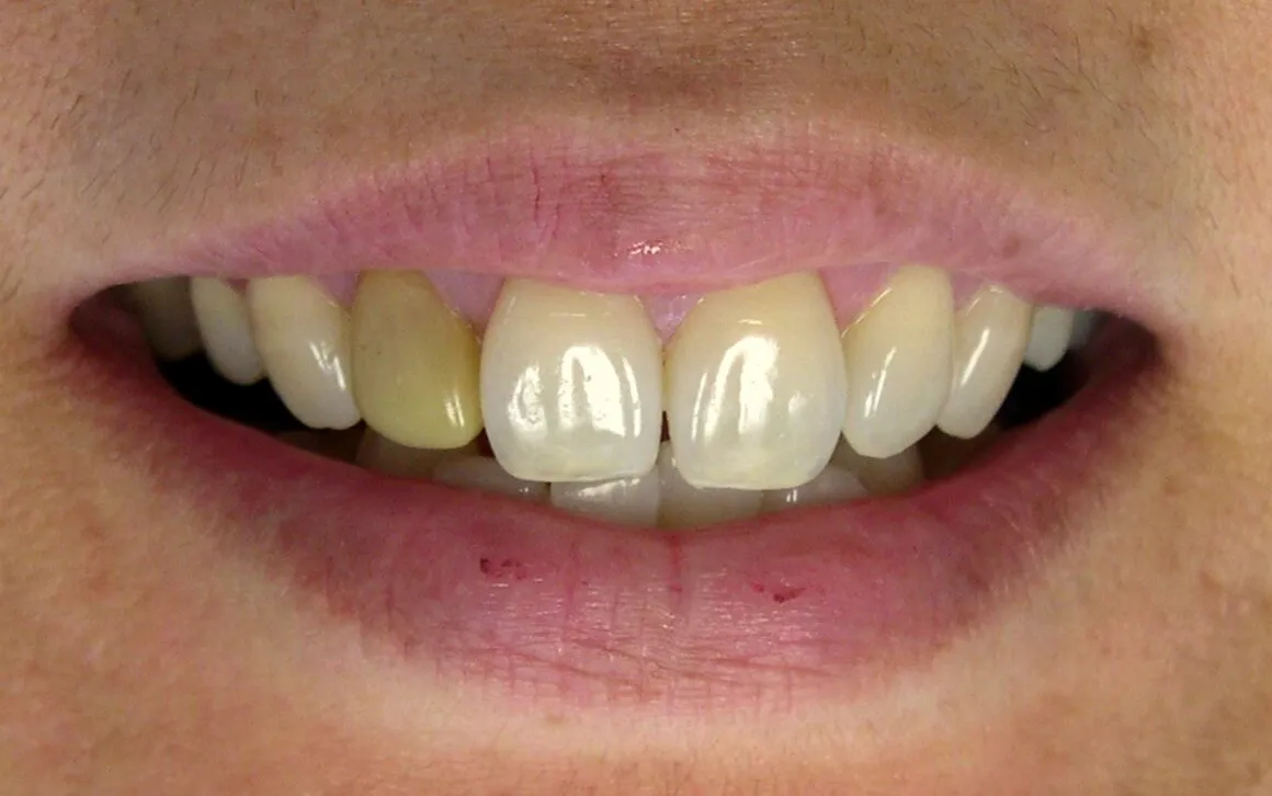 25660 whitening strips gels