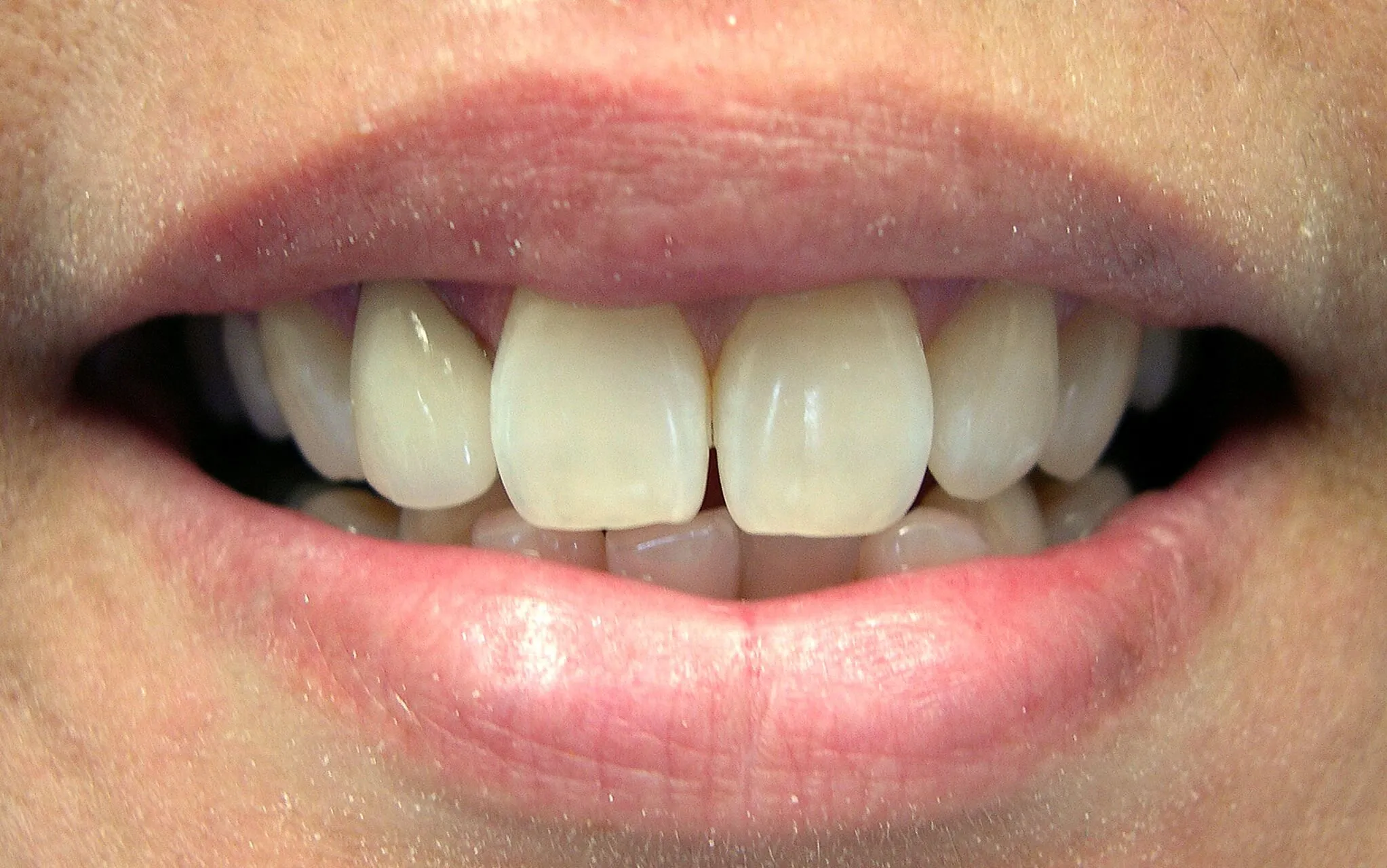 25660 whitening toothpastes