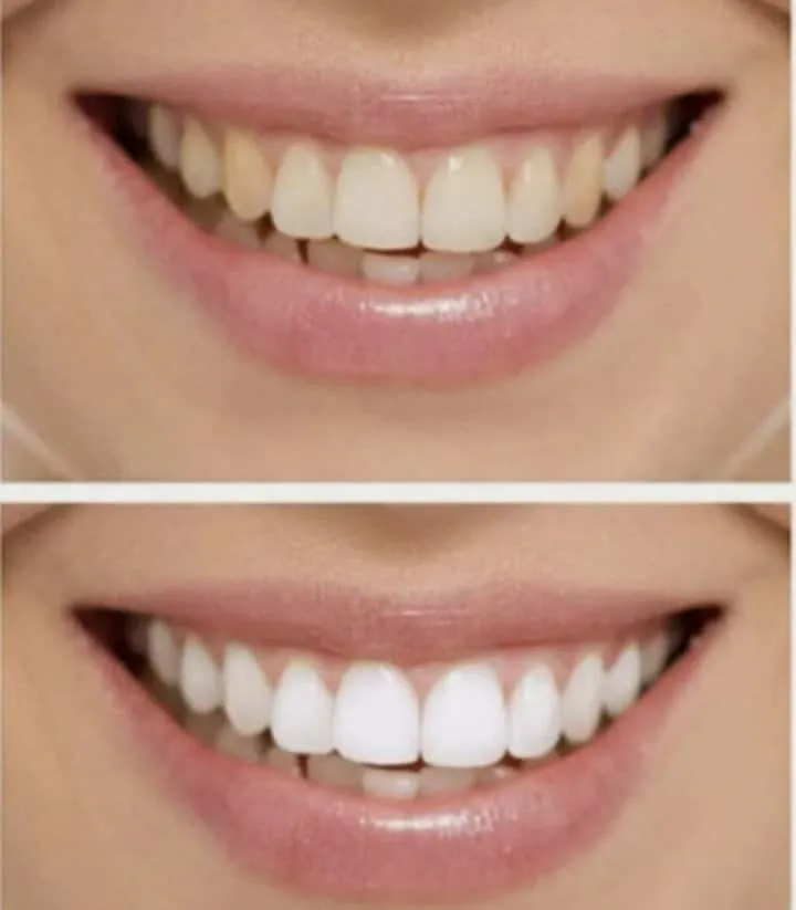 25670 sensitive teeth
