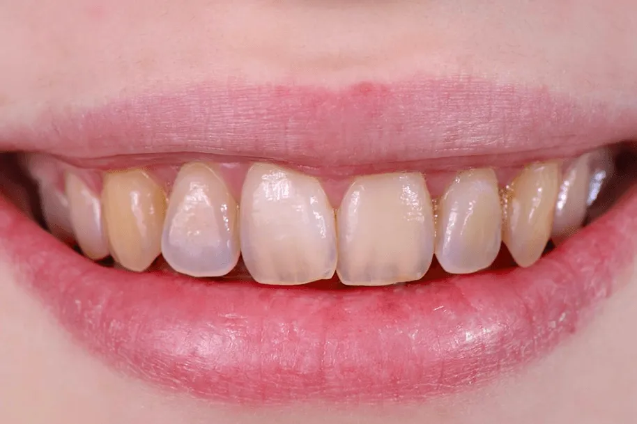 25676 enamel erosion