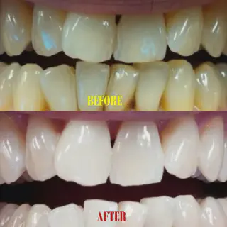 /img/25677-baking-soda-teeth-whitening-image7.webp