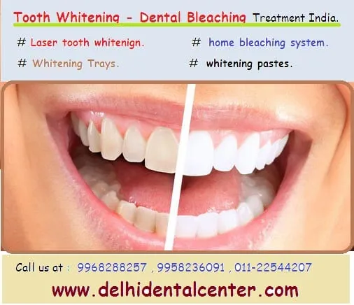 25679 laser tooth whitening overview
