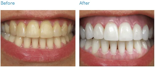 25681 teeth whitening boston ma image1
