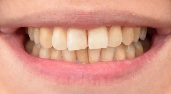 25681 teeth whitening boston ma image2