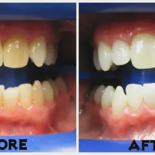 /img/25681-teeth-whitening-boston-ma-image7.webp