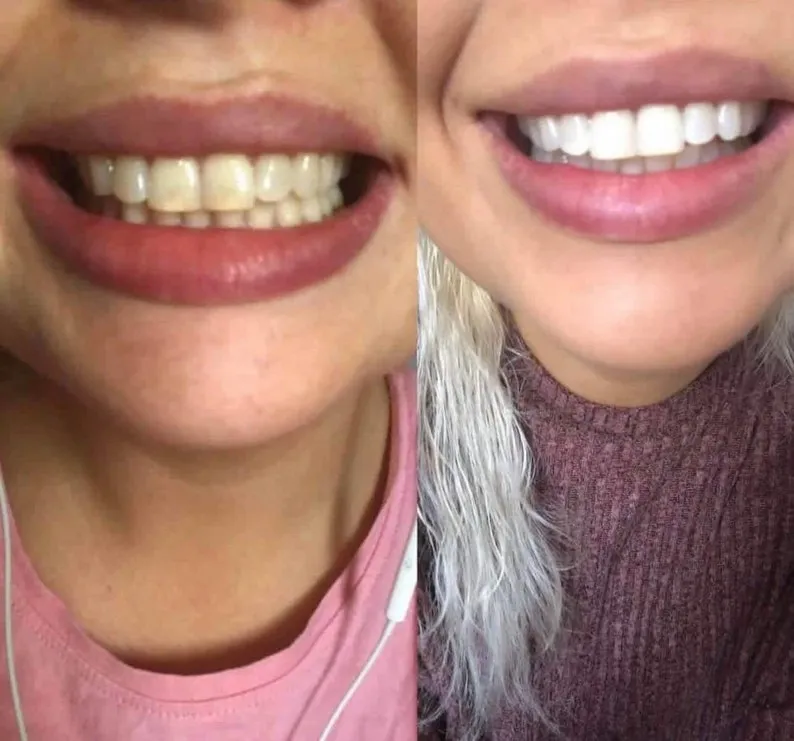 25689 crest strips before after