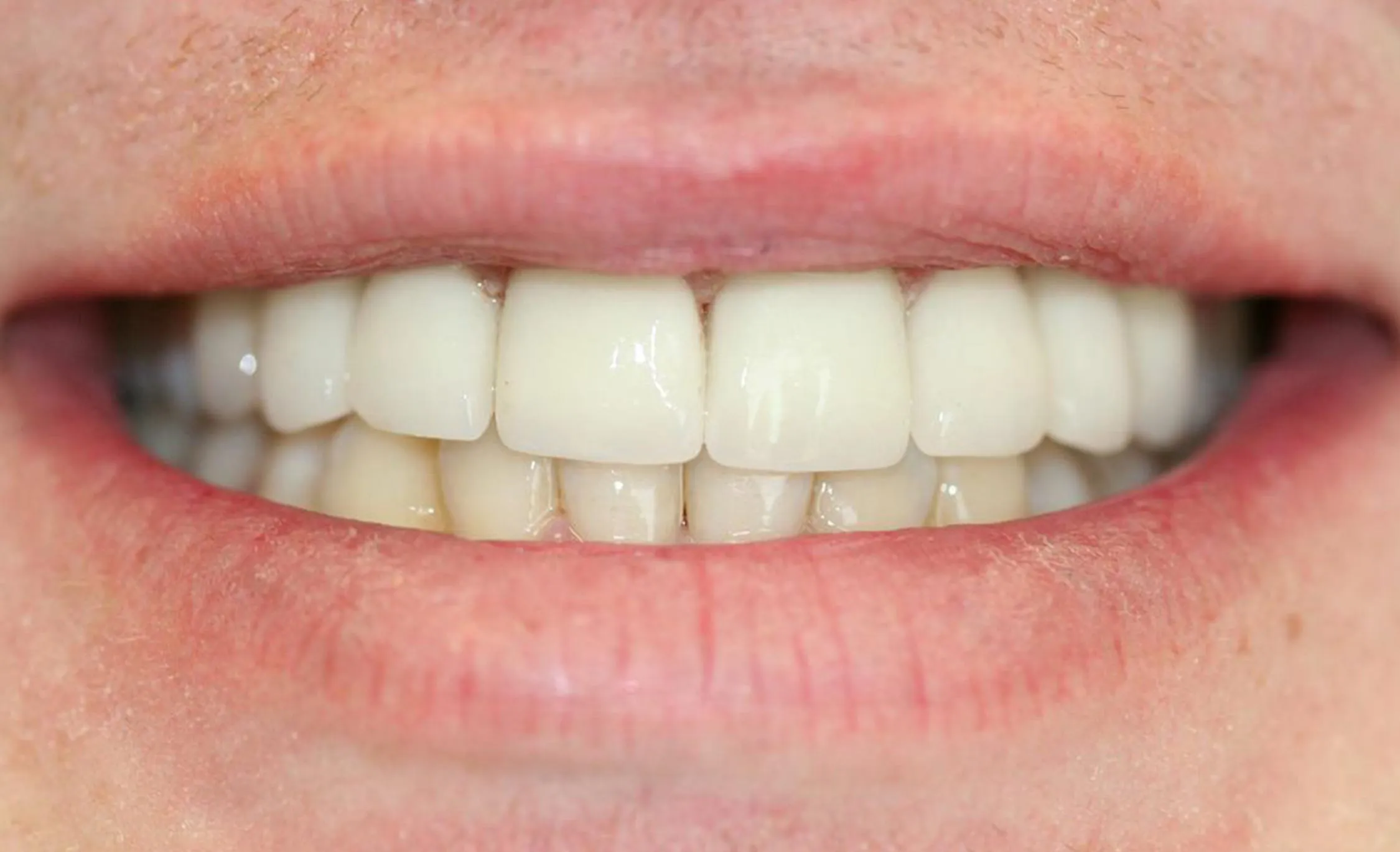 25690 at home teeth whitening kit