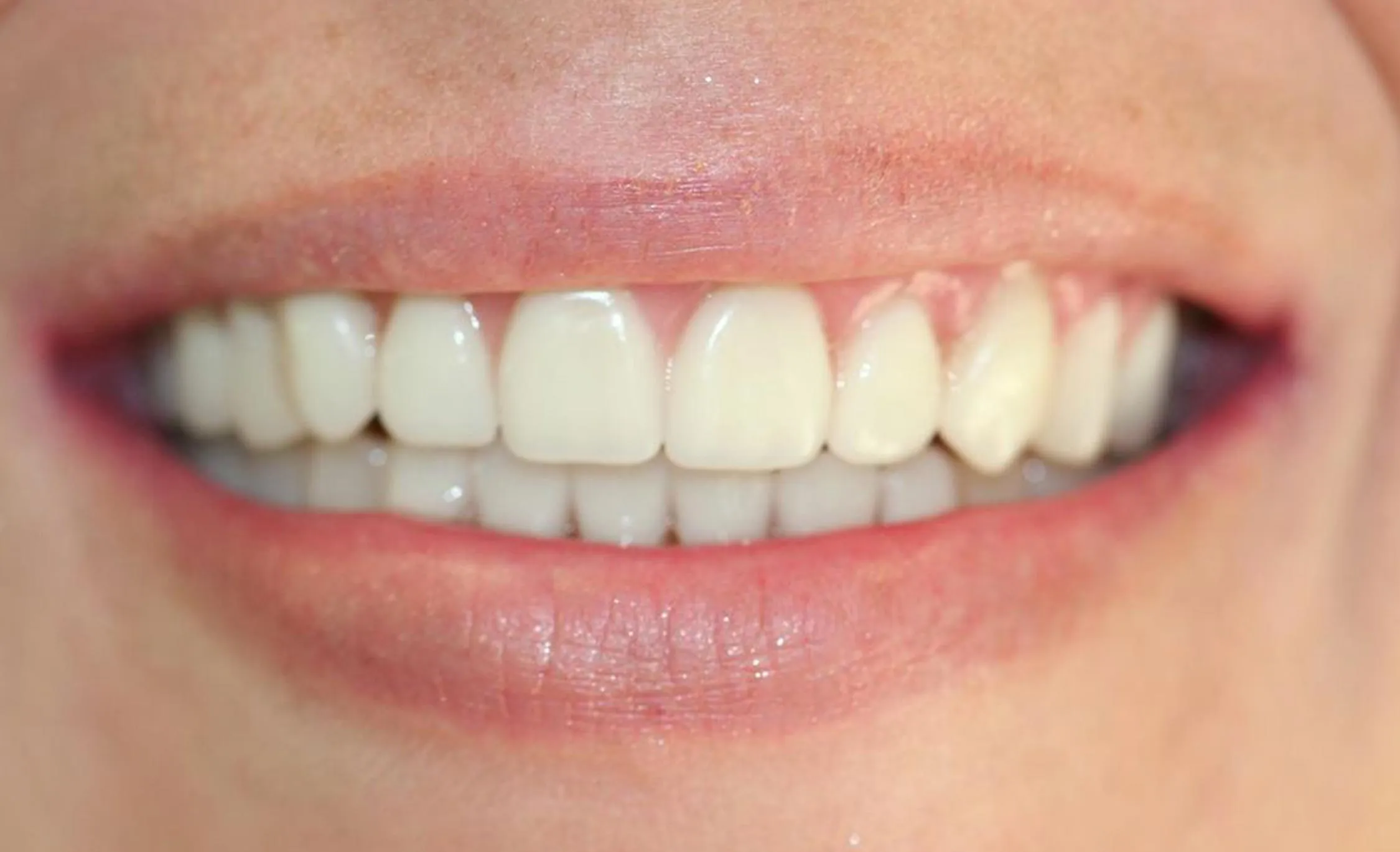 25690 in office teeth whitening