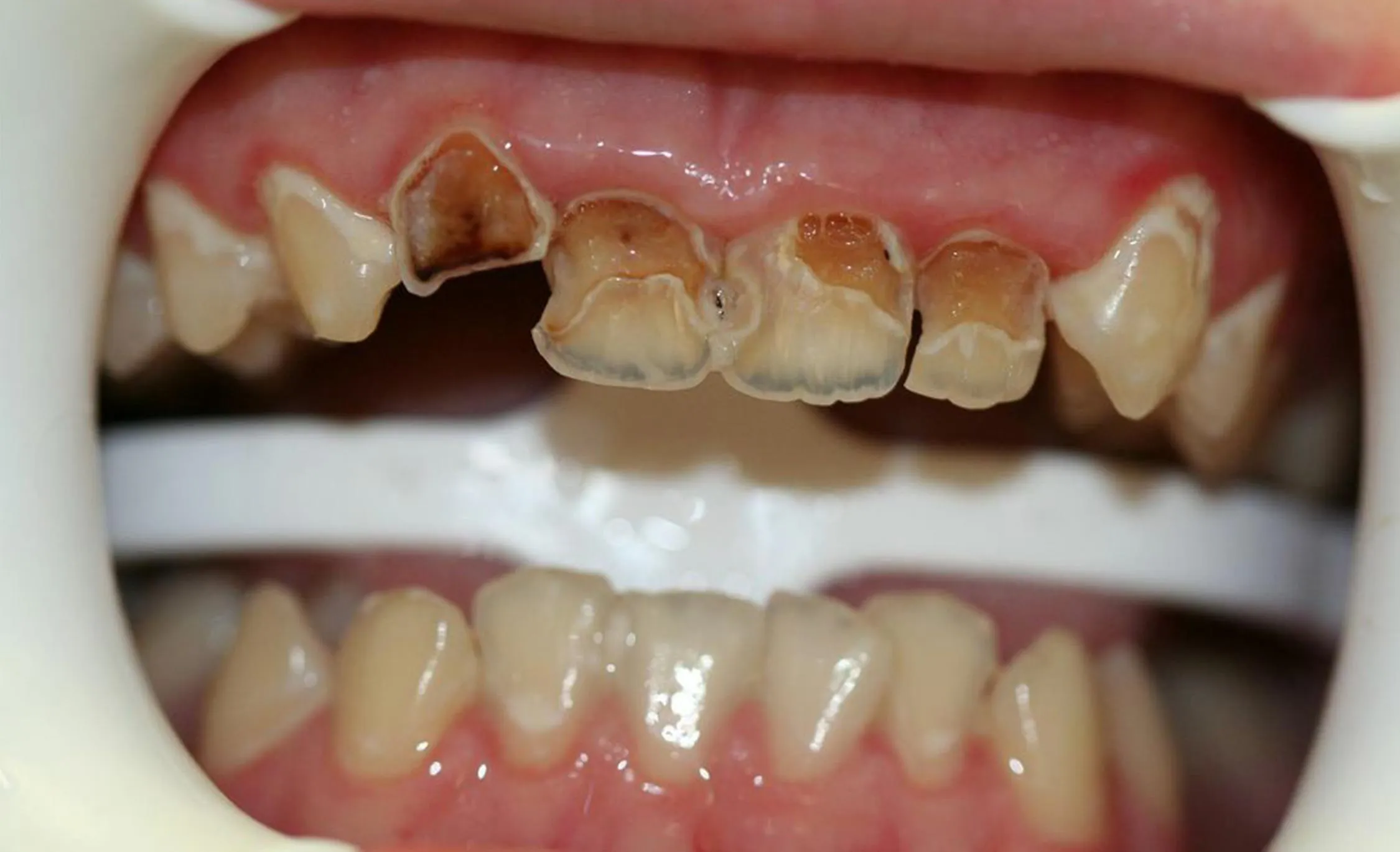 25690 oral hygiene teeth