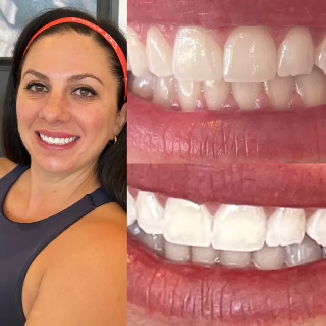 25693 professional teeth whitening