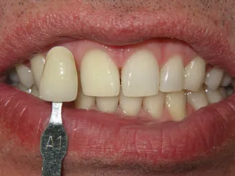 25695 oral health teeth whitening