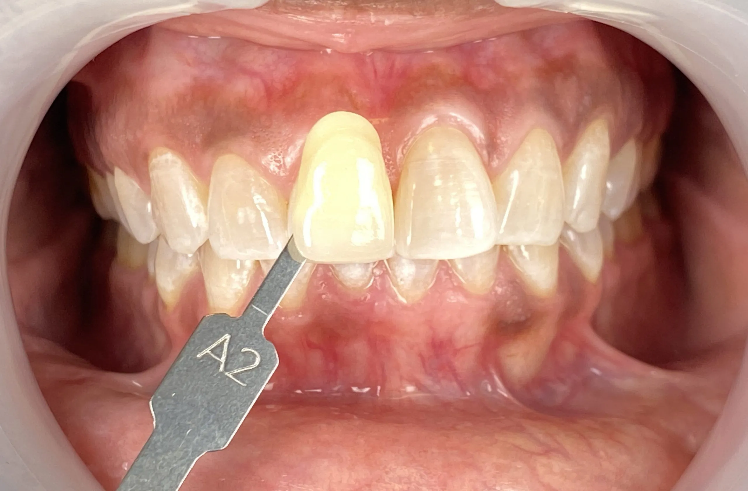 25695 professional teeth whitening