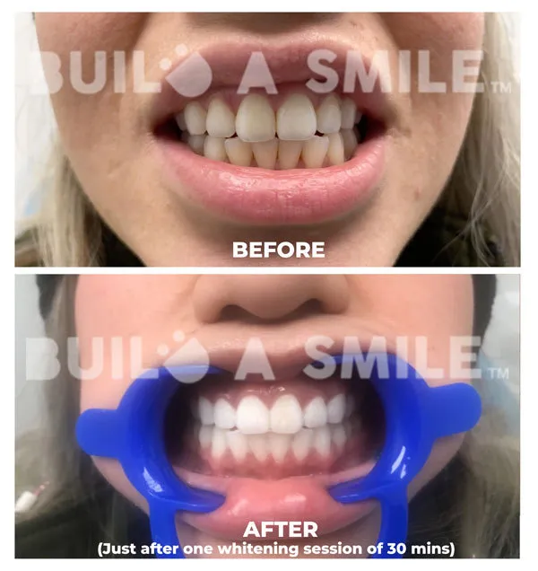 25696 at home teeth whitening