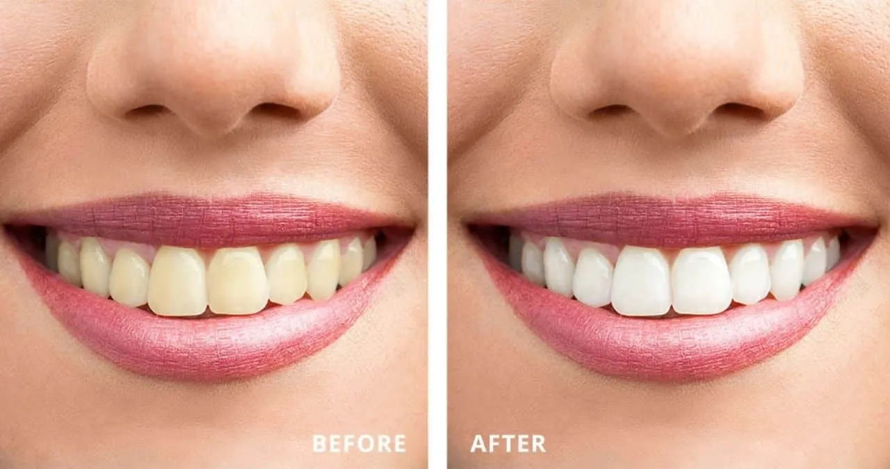 25696 in office teeth whitening