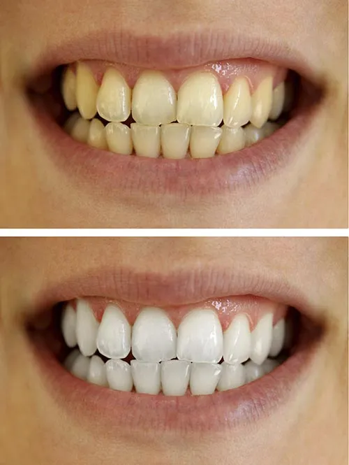 /img/25696-teeth-shade-chart.webp