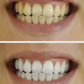 /img/25696-teeth-shade-chart.webp