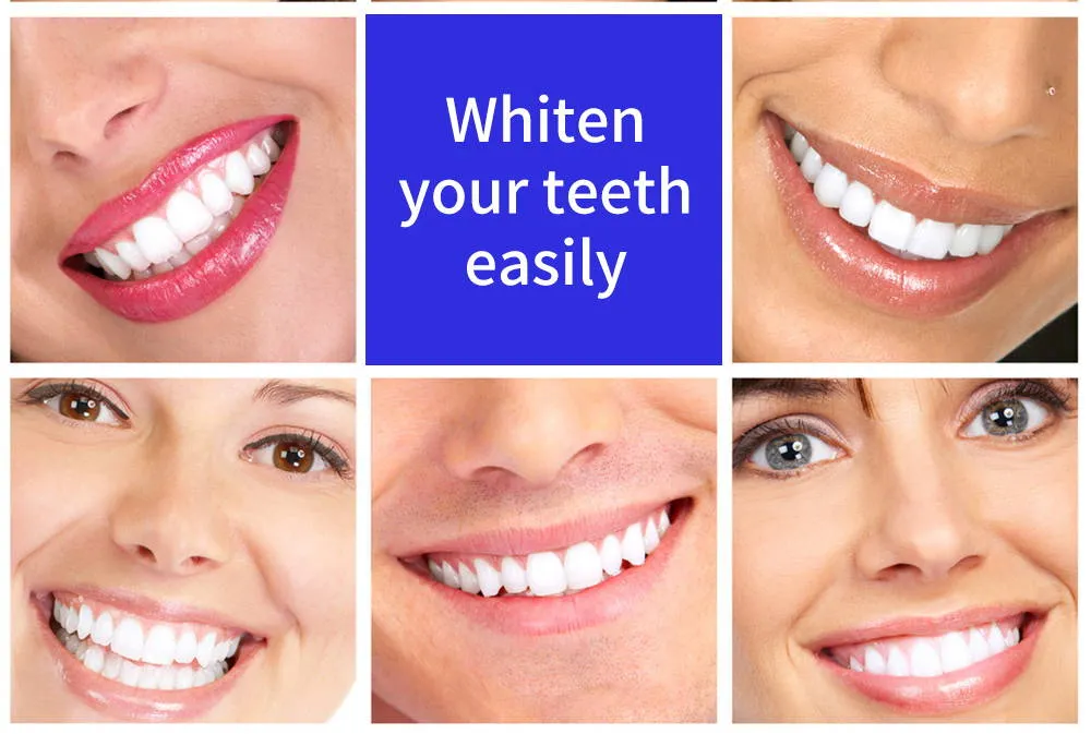 25696 teeth whitening options