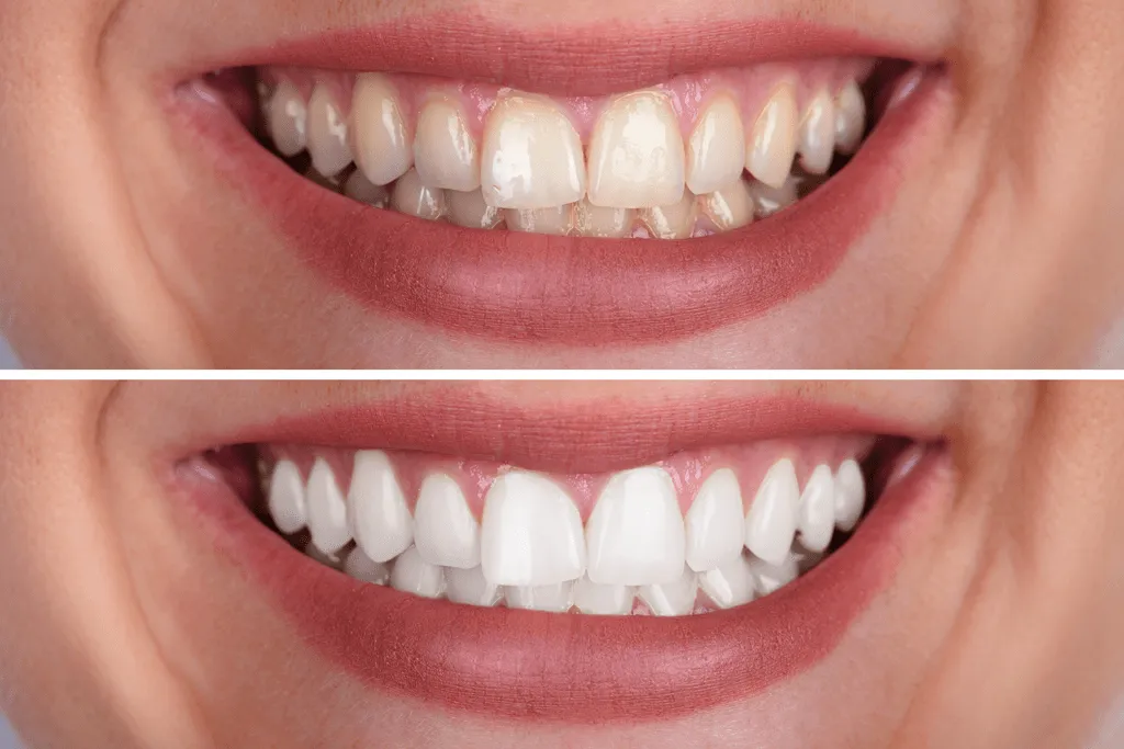 25700 teeth whitening odessa tx image1