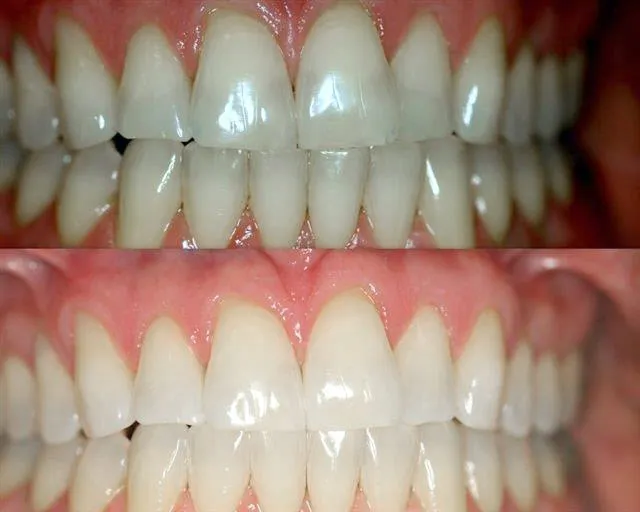 25703 teeth whitening boynton beach fl 6